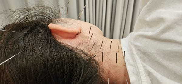 耳の鍼施術